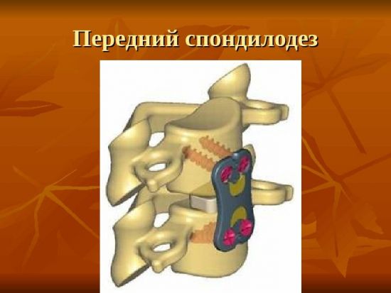 Анкилозирующий спондилит (болезнь бехтерева)
