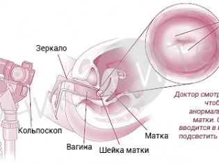 Вульвовагинит. причины, симптомы, признаки, диагностика и лечение вульвовагинита. виды вульвовагинита: острый, хронический, атрофический, специфические виды. бактериальный, кандидозный, трихомонадный уретрит