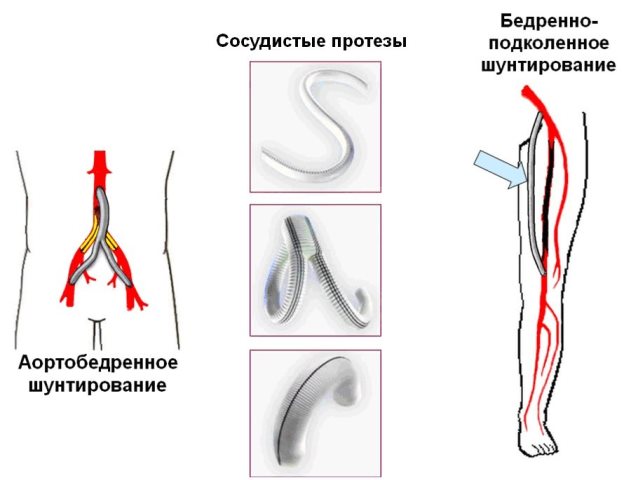 Профилактика облитерирующего эндартериита
