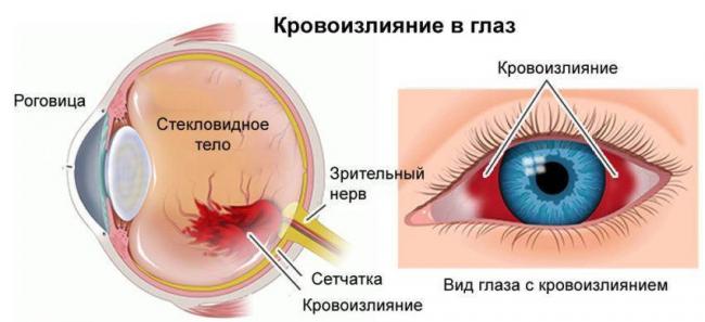 Как вылечить кровоизлияние в глазу народные средства