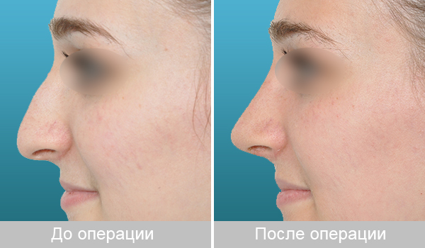 Ринопластика – красивый нос всем к лицу