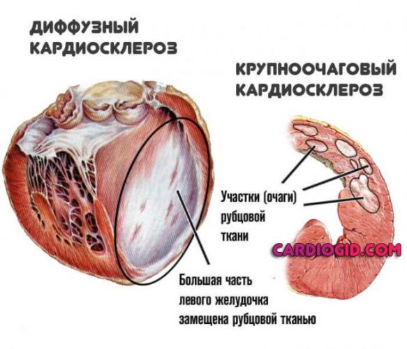 Атеросклеротический кардиосклероз: причины, симптомы и лечение