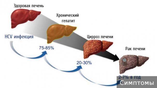 Фиброз печени 4 степени и гепатит с: лечение, сколько живут, прогноз