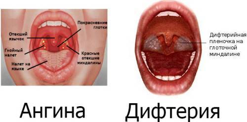 Чем полоскать горло?