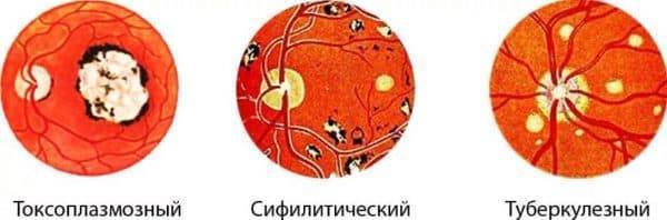 Хориоретинит глаза: что это такое, виды (центральный серозный, токсоплазмозный, туберкулезный, сифилитический, острый, очаговый), причины, симптомы, лечение, диагностика, осложнения, берут ли в армию