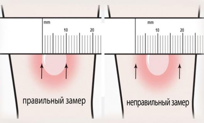 Реакция на манту отрицательная: как выглядит и что означает