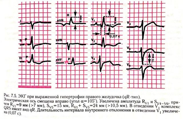 Гипертрофия правого желудочка что это и как можно лечить