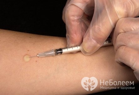 Сонная болезнь — симптомы, возбудитель, лечение сонной болезни