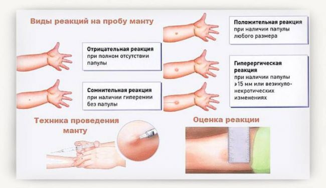 Плохая реакция манту у ребенка