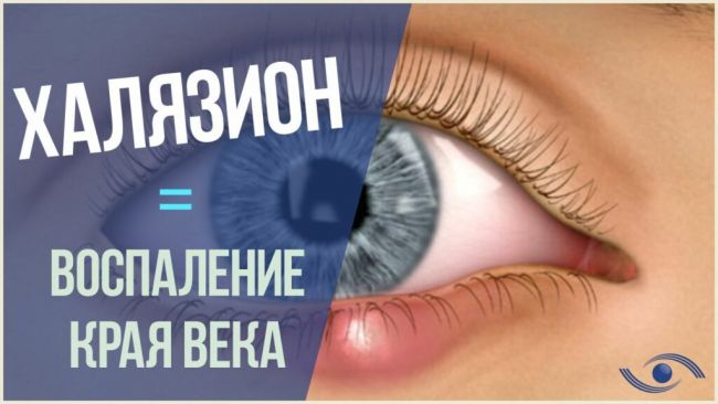 Халязион верхнего и нижнего века: фото глазной болезни, причины возникновения, симптомы и удаление