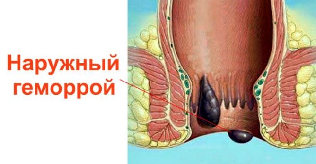 Мазь от геморроя при беременности флеминга