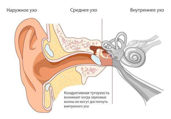 Лечение тугоухости