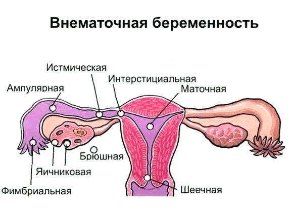 Внематочная беременность – как определить на ранних сроках?
