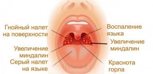 Лечение ангины: сумамед