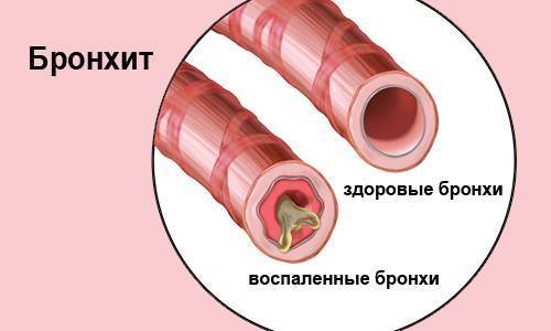 Компресс от кашля для детей из вареной картошки