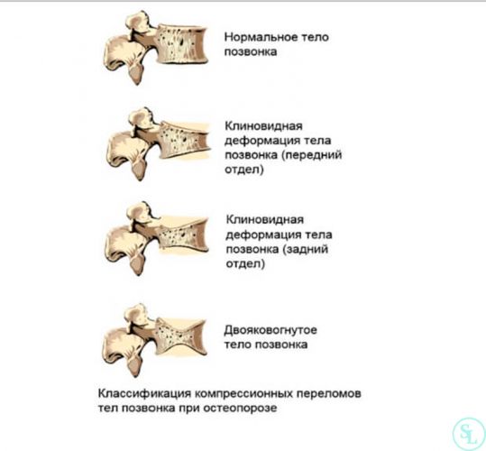 Лечение и последствия у взрослых с компрессионным переломом позвоночника грудного отдела