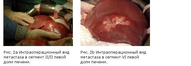 Доброкачественные опухоли печени. гемангиомы