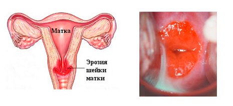 Эрозия шейки матки: симптомы и лечение
