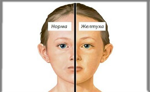 Диета повышенный билирубин в крови у