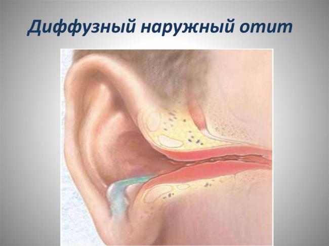 Чем лечить уши если заложило при простуде