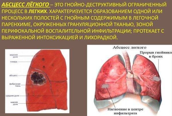 Мокрота: понятие, из чего состоит, виды и возможные цвета и диагностика по ним, обзор заболеваний