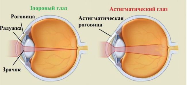 Сложный миопический астигматизм обоих глаз: что это такое и как лечить
