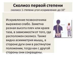 Как определить сколиоз на ранней стадии