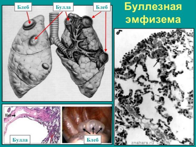 Другая хроническая обструктивная легочная болезнь