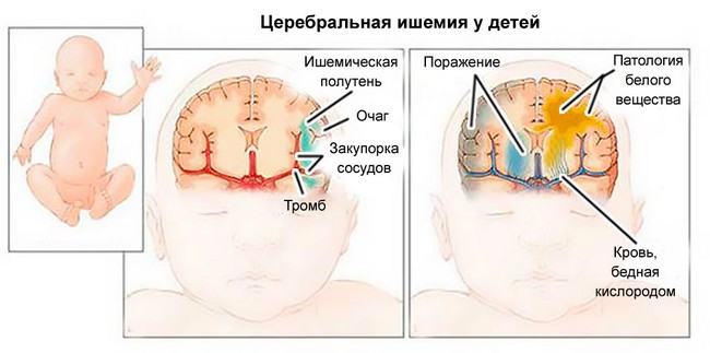 Церебральная ишемия у новорожденных: симптомы, степени, лечение, последствия