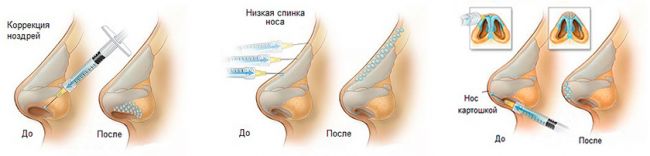Коррекция формы и функции носа (риносептопластика)