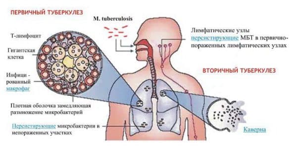 Контакт с туберкулезом