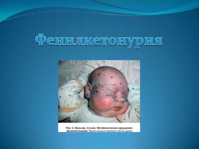 Фенилкетонурия