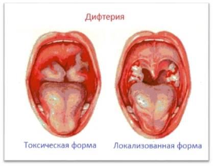 Какие бывают лор-заболевания горла и гортани, острые и хронические проявления, терапия
