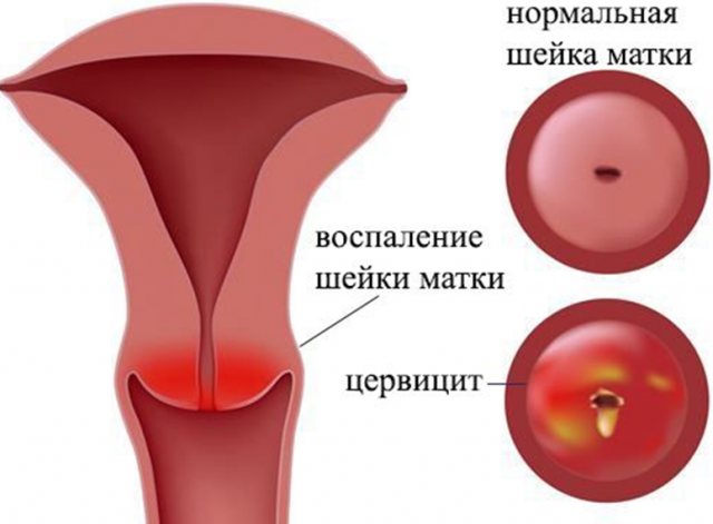 От чего помогает «лонгидаза» (свечи). инструкция по применению, цена и аналоги