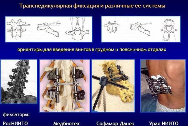 Травма позвоночника транспедикулярная фиксация