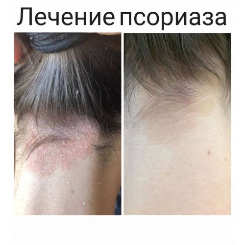 Лечение себорейного дерматита в детском возрасте