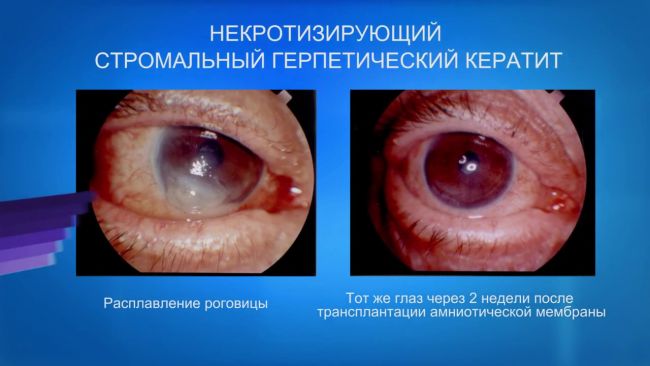 Кератит