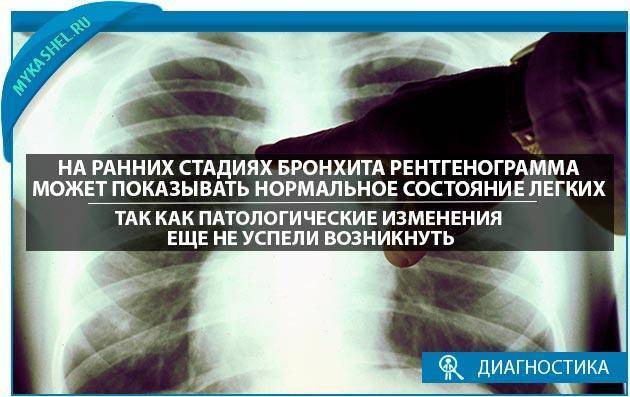 Рентгеновское исследование при пневмонии. симптомы, признаки, описание рентгена при пневмонии