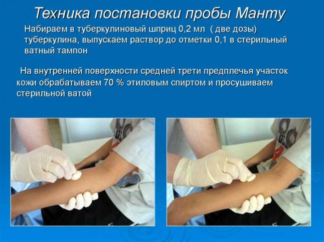 Постановка реакции манту