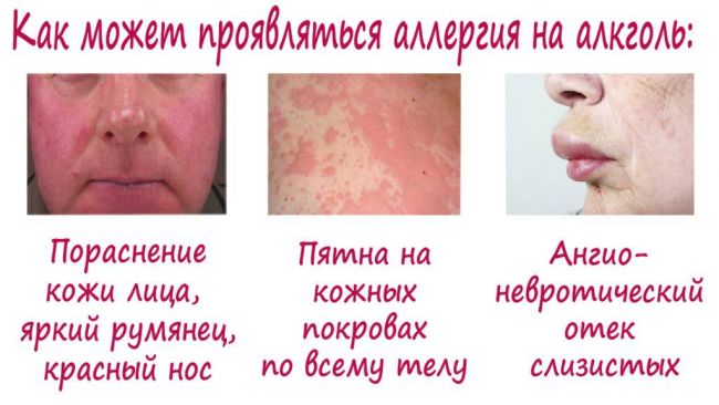Аллергия на алкоголь: симптомы у взрослых и как избавиться от аллергии на пиво, вино, водку и другие напитки