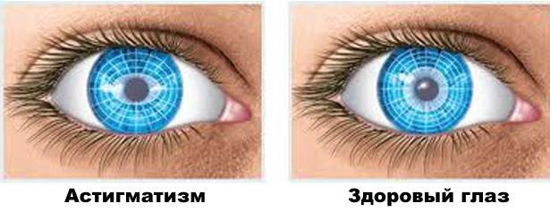 Описание дальнозоркого (гиперметропического) астигматизма и его лечение