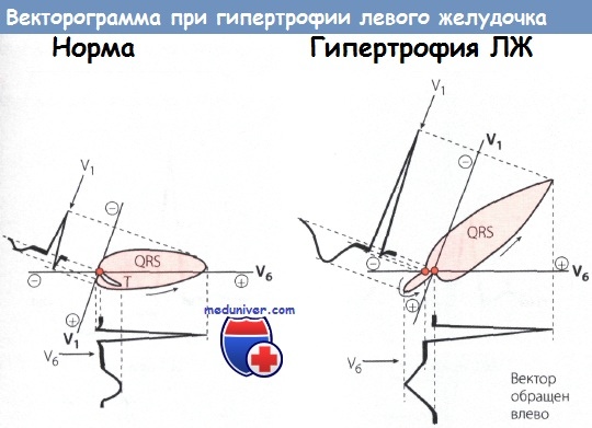 Гипертрофия левого желудочка сердца