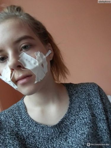 Последствия прокола при гайморите