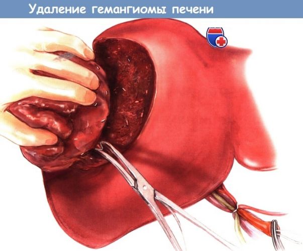 Гемангиома печени и питание диета при гемангиоме