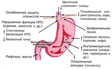 Гастроэзофагеальная рефлюксная болезнь