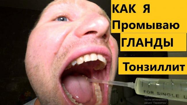 Что делать, если из горла выходят белые комочки с неприятным запахом?