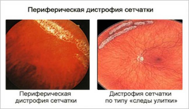 Периферические витреохориоретинальные дистрофии