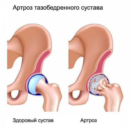 Инструкция по реабилитации после эндопротезирования коленного сустава: упражнения, гимнастика и советы