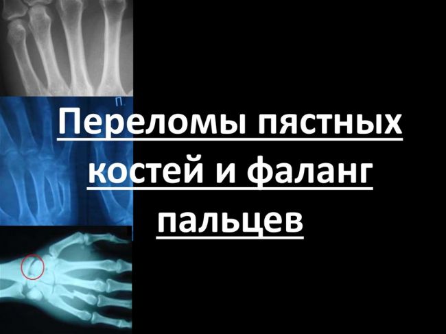 Перелом лучевой кости. причины, симптомы, виды, первая медицинская помощь и реабилитация