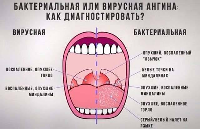 Как раз и навсегда вылечить хронический тонзиллит
